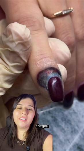 Mirella Perdigão | Saúde das Unhas & Onicotécnico 🇧🇷 on Instagram: "O hematoma ungueal é o acúmulo de sangue sob a unha ou ao redor dela após um trauma. Ele não surge do nada ,é sempre consequência de uma agressão aos vasos sanguíneos da região. Pode acontecer ao: • sofrer uma batida • pressionar excessivamente durante procedimentos • usar calçados apertados (nos pés) • repetir pequenos traumas ao longo do tempo Quando os vasos se rompem, o sangue extravasa e fica preso sob a lâmina ou nos tec