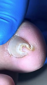 What popped out of this nail shocked viewers 704U Beautiful moments of care and relaxation through a gentle pedicure experience. Simple, clean, and satisfying. 🌿✨ Disclaimer: This video is for educational and relaxation purposes only. All content belongs to the respective owners, no copyright infringement is intended. | Marcia Villa