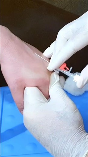 IV Cannulation Technique