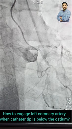 How to engage left coronary ostium when tip of catheter located below it?