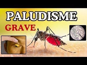 What is SEVERE MALARIA? Everything you need to know about Malaria - MALARIA: Species, Cycle, Diag...