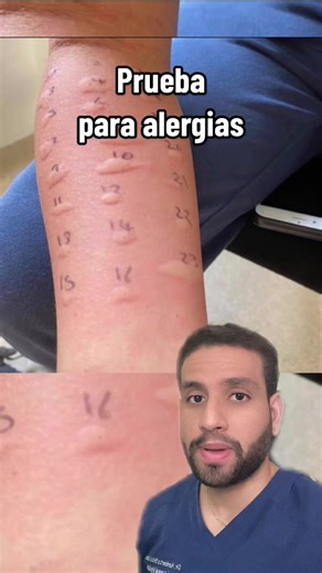 Prueba de Alergias: ¿Eres Alérgico y No Sabes a Qué?