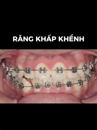 Nong hàm và điều trị khấp khểnh cho trẻ 14 tuổi ở Ba Đình