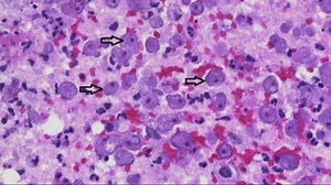 VERIFY: Can using tap water in a Neti pot lead to a deadly brain infection?