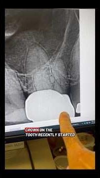 No cbct. RCT of tooth 3 using @FlexivoDental products. #dentists #rootcanaltherapy #dentaltreatment