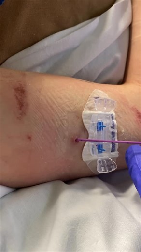 Irene Bernhardt on Instagram: "PICC line removal I started to get pain and soreness in my arm where my PICC was a few days ago. When it became hard to flush and my skin began to break out, I decided to go to the ER to get it checked out. After blood tests and ultrasounds, they found swelling and a blood clot in my vein that the PICC was in- phlebitis/STV (superficial vein thrombosis). Thankfully it was nothing too serious like an infection or a DVT (deep vein thrombosis). The next morning I got