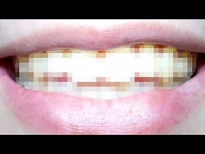 This is what happens when I breed caries bacteria.