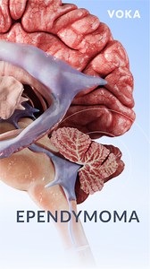 Ependymoma: a rare central nervous system tumor explained in 3D 📌 Learn more about the human body with VOKA 3D Anatomy & Pathology! #ependymoma #braintumor #neurooncology #3Danatomy #3Danimation #3Dvisualization #3Dmedicalvisualization #3Dmedicalanimation #3danatomy #medstudents #medicaleducation #anatomy #pathology #3danatomy #digitallearning #humanbody | VOKA 3D Anatomy & Pathology