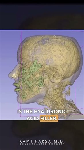 Not only does it SPREAD but also cause tissue expansion 🤯