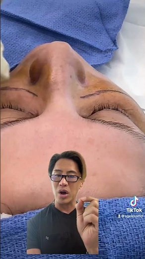 Endolift Skin Tightening Treatment - Ageless MD