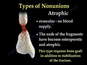 Fracture Nonunion - Causes, Types and Treatment • Video • MEDtube.net