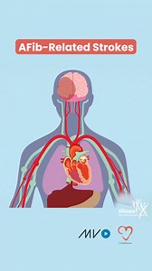 Did you know atrial fibrillation (AFib) increases the risk of ischemic stroke? 🫀🧠 Early detection and treatment of AFib are key to reducing stroke risk. Whether through medication, lifestyle changes, or procedures, managing AFib is crucial to prevent ischemic strokes. Join us for our discussions on stroke, one this Wednesday about prehospital care of stroke, and one on World Stroke Day on the 29th about AFib, obesity, and stroke! . . . . . #AFib #StrokePrevention #IschemicStroke #AtrialFibrill