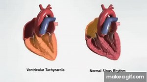 What is Ventricular Tachycardia (VT)? on Make a GIF