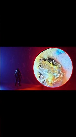 The Truth About earwax Will Shock You. How to remove earwax from ear, earwax extractions