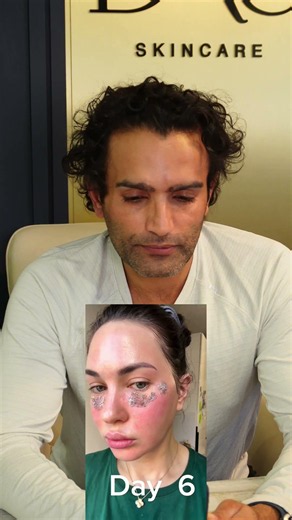 CO2 laser before & after: skin resurfacing, pores, wrinkles & acne scar treatment‼️ #dermatology