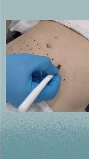 Body contouring with Aqualyx and Ultrasound Cavitation #fatdissolving #body #aqualyx