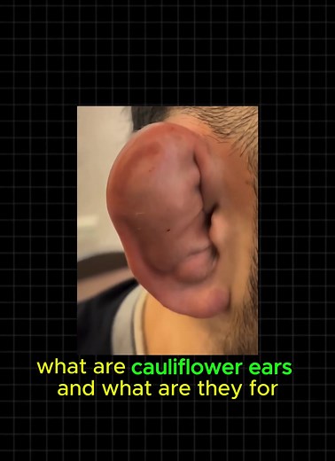 INSTRUCTIONS FOR CAULIFLOWER EARS IN PROFILE HEADER🔥🥦#cauliflowerear #tutorialcauliflowerears #wrestling #europe #europewrestling #fyp #france🇫🇷 #germany
