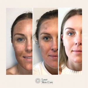 Fraxel Laser - Laser Skin Care