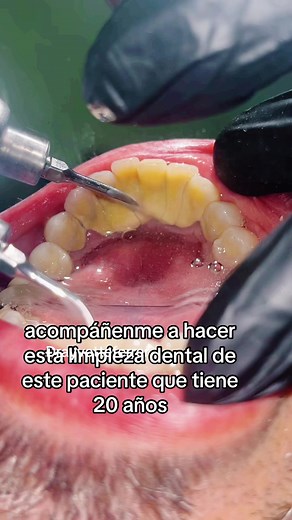Limpieza dental y tratamiento de fluorosis en dientes