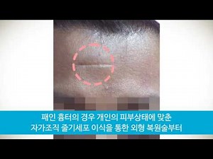 오래된 이마 흉터 제거 시술2 (Forehead scar removal procedure2)