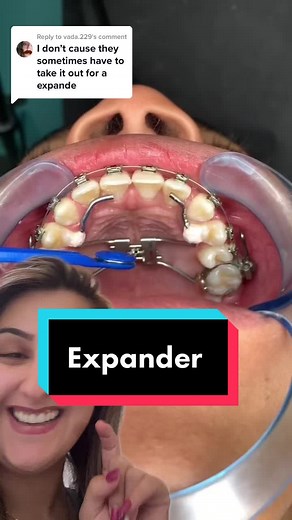 Replying to @vada.229 have you seen ?! What’s is this 😜 #teethtok#drshammout#dentaloffice#bracestips#bracesstruggle#braceson2#bracescolors#bracesguide#braceschallenge#bracescheck#bracestiktok#bracestory#duet@Dr. Diler Cruz #bracescase #greenscreenvideo
