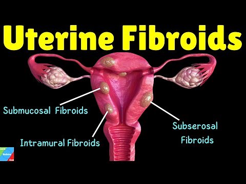 Uterine Fibroids: Types, Symptoms, Causes, Diagnosis, Treatment and Complications - Gynecology