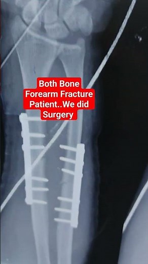 Both Bone Forearm Fracture Patient..We did Surgery ..Dr Sai Chandra #fracturetelugu