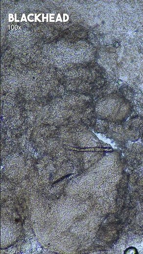 Studying the structure of blackheads under magnification. | TULO - Microscope