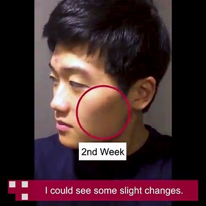 9.2K views · 48 reactions | Red Erasing Cream removed the acne scars over time! Get clean and evened out skin! Shop Now! >> https://goo.gl/zaZBuC | Medicube | Facebook