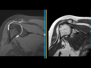 Shoulder pain after rotator cuff surgery