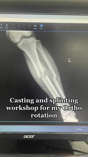 Orthopaedic Casting and Splinting: Demo and Removal Process Explained