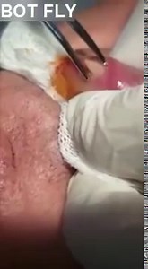 WARNING GRAPHIC: Guy Has Huge Botfly Larvae Removal