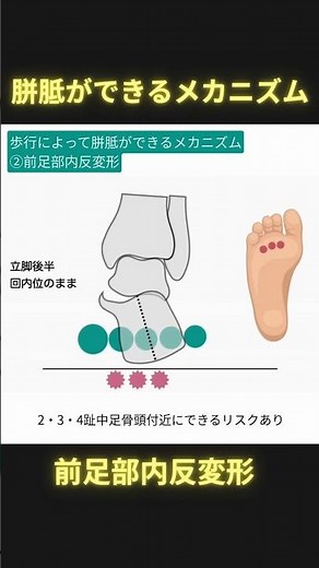歩行によって胼胝ができるメカニズム②前足部内反変形 #理学療法 #ptタイガー #日本足病学協会 #足病学
