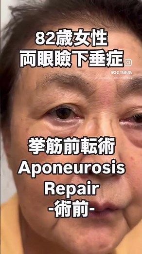 【術前&術後】82歳女性 眼瞼下垂手術に対する挙筋前転術