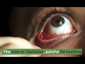 The stye or chalazion, painful eyelid.