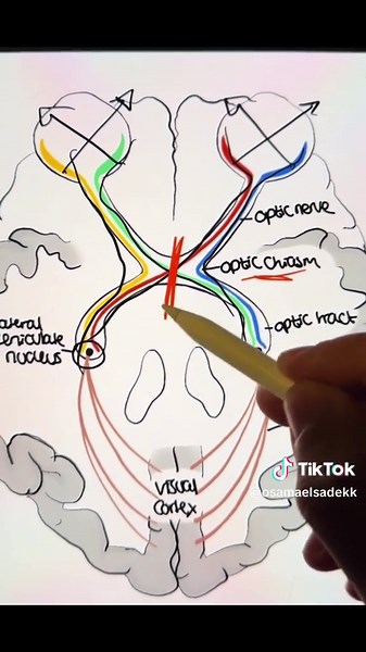 Visual field defects in 2 rules!!👀 . . . . . . . . . . . . . . . . . . . . . . . #medicine #medicalstudent #fyp #طب_بشري #الطب #neuroscience #medical #ophthalmology