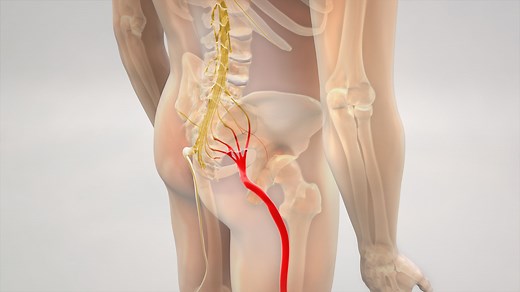 Sciatica Surgery: Everything You Need to Know