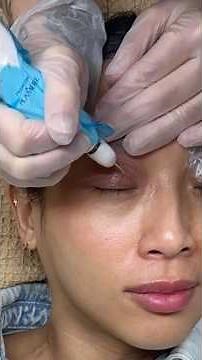 Plasma fibroblast eyelid lift Before and after