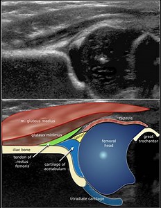 💥 Ultrasound of Neonatal developmental dysplasia of hip joint (DDH) :: Dr. Mohamed Soliman | Radiology Courses