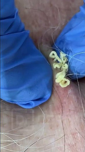 SILLY STRING POP! | Dr. Derm