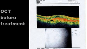 94K views · 402 reactions | Stem cell treatment for Macular...