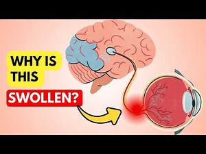 Papilledema: When High Brain Pressure Threatens Your Vision