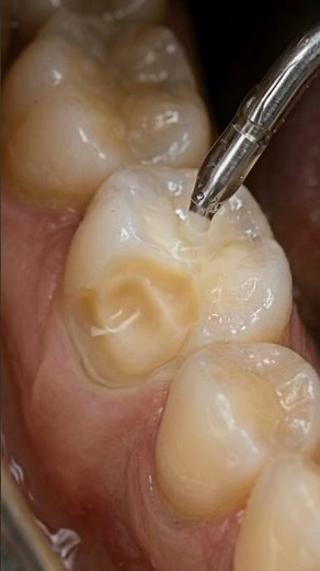 How Dentists Rebuild a Severely Broken Tooth 🦷 Premolar Reconstruction | #toothcraft #asmr