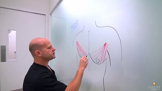 Double Incision Top Surgery