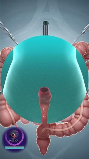 Colectomy Procedure Overview: Why and How Colon Surgery Is Performed