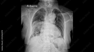Diagnostic PA Chest X-ray: Comprehensive Assessment of Thoracic Health and Respiratory Conditions