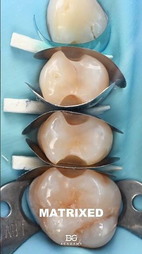 MOD restorations. #composite #compositerestoration #dentaleducation