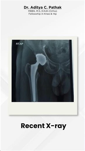 From Fracture to Recovery: A Hip Surgery Success Story