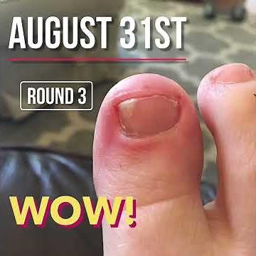 TERBINAFINE LAMISIL Toe Nail Fungus!!! Before and After