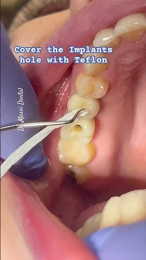 covering the access hole of a screw-retained implant crown with Teflon tape